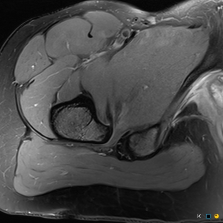 Figure 3 for case reverse slipped upper femoral epiphysis